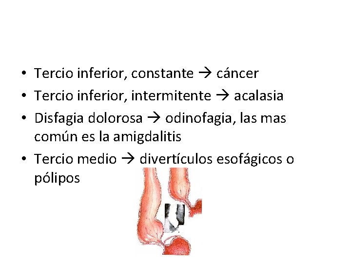  • Tercio inferior, constante cáncer • Tercio inferior, intermitente acalasia • Disfagia dolorosa