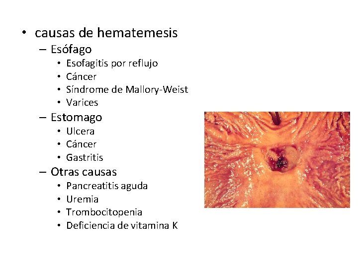  • causas de hematemesis – Esófago • • Esofagitis por reflujo Cáncer Síndrome