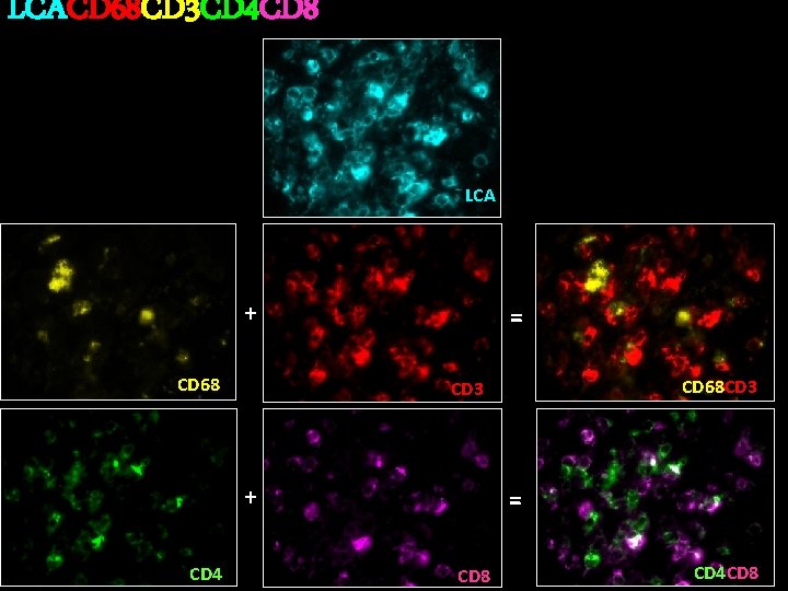 LCACD 68 CD 3 CD 4 CD 8 LCA + CD 68 = +