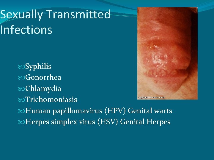 Sexually Transmitted Infections Syphilis Gonorrhea Chlamydia Trichomoniasis Human papillomavirus (HPV) Genital warts Herpes simplex