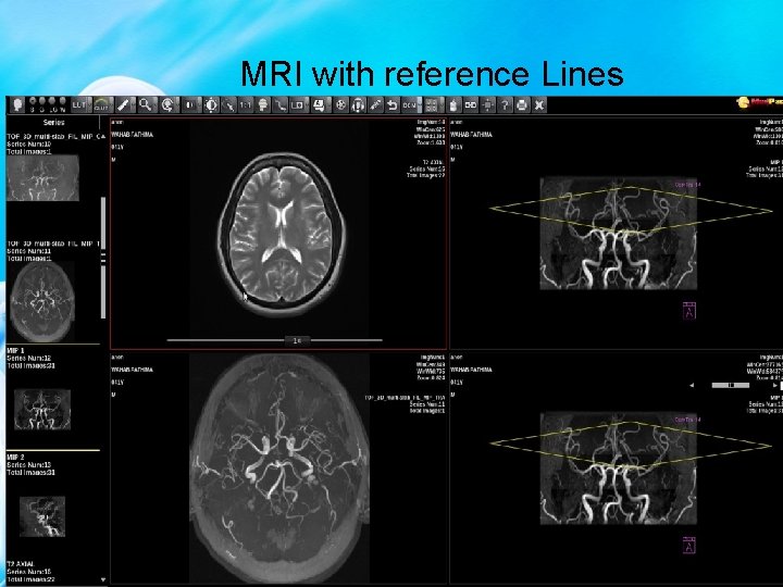MRI with reference Lines 