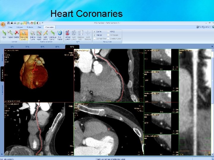 Heart Coronaries 