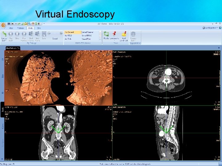 Virtual Endoscopy 