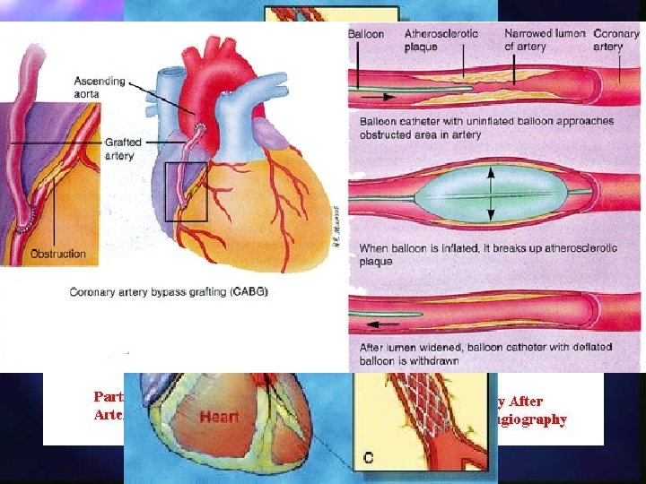 Atherosclerosis – Heart - AP n Narrowing of coronary arteries leads to ischaemia (inadequate