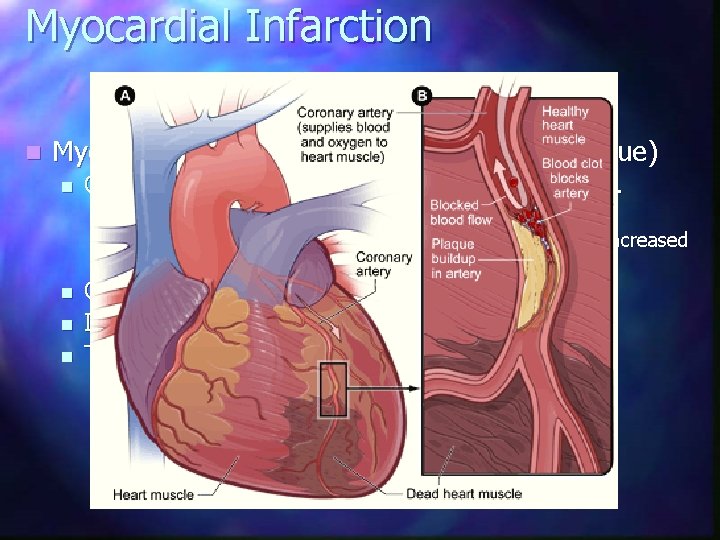 Myocardial Infarction n Myocardial infarction – MI (death of heart tissue) n Caused by