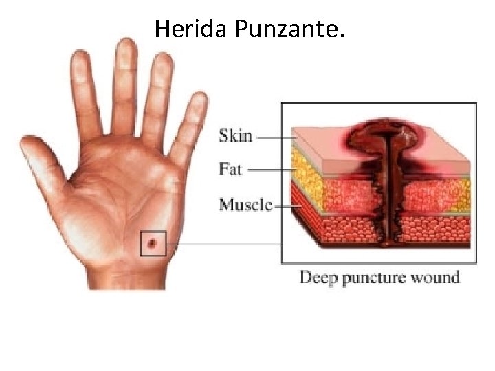 Herida Punzante. Herida Punzante.