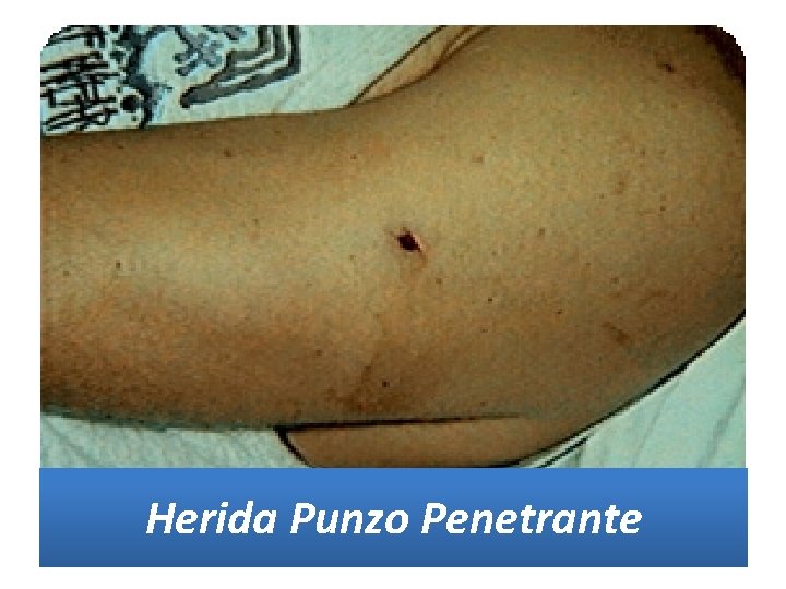 Herida Punzo Penetrante Herida Punzo Penetrante