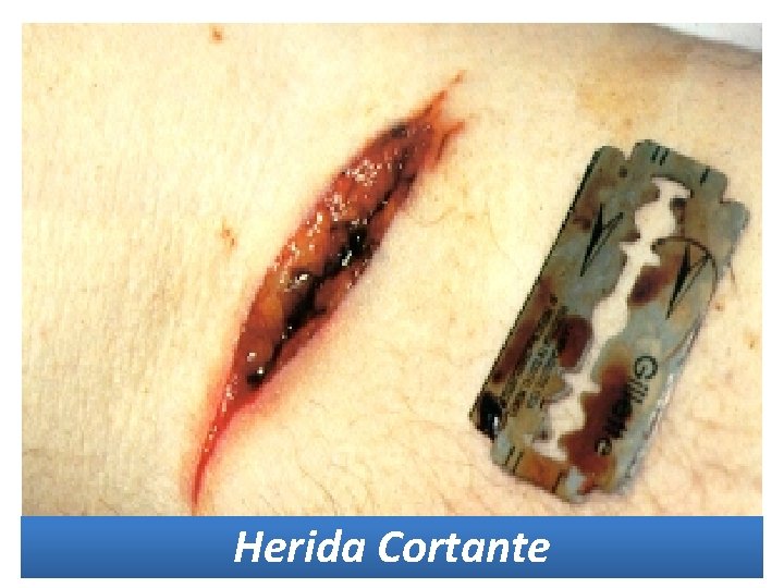 Herida Cortante Herida Cortante
