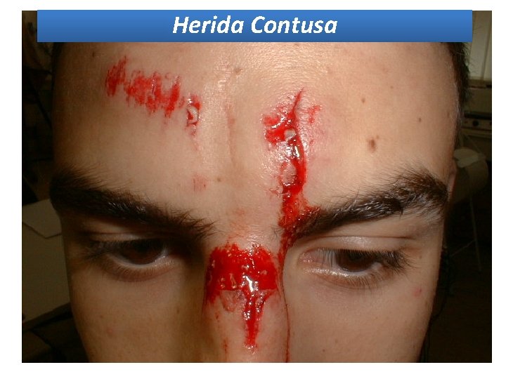 Herida Contusa Herida Contusa