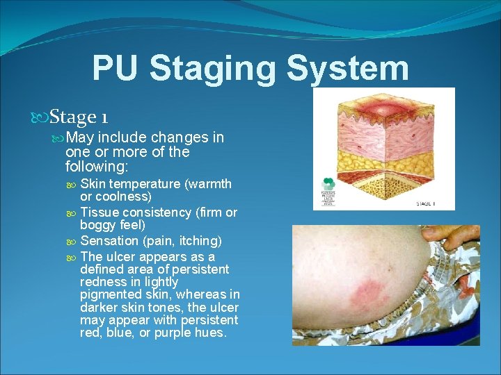 PU Staging System Stage 1 May include changes in one or more of the
