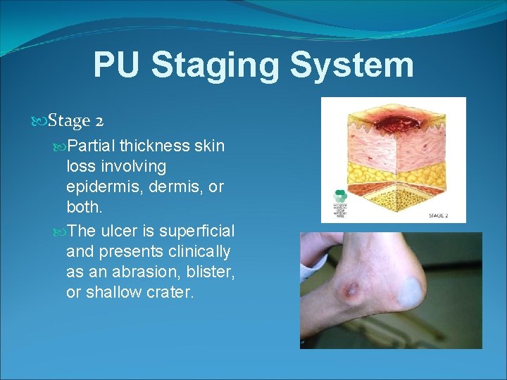 PU Staging System Stage 2 Partial thickness skin loss involving epidermis, or both. The