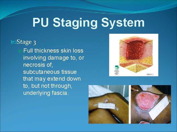 PU Staging System Stage 3 Full thickness skin loss involving damage to, or necrosis