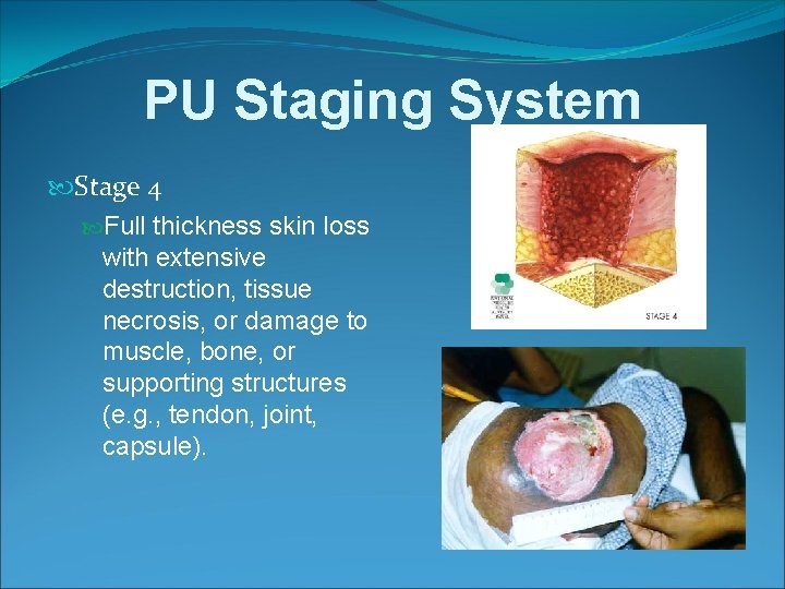 PU Staging System Stage 4 Full thickness skin loss with extensive destruction, tissue necrosis,