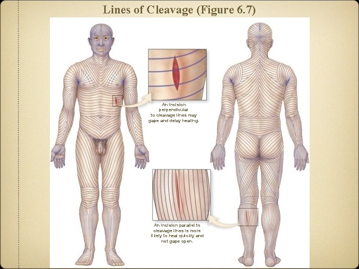 Lines of Cleavage (Figure 6. 7) An incision perpendicular to cleavage lines may gape