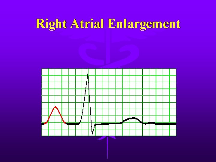 Right Atrial Enlargement 
