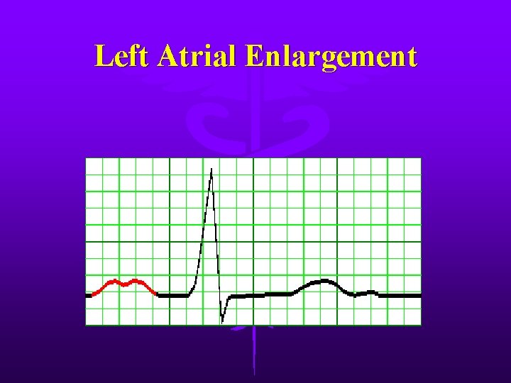 Left Atrial Enlargement 