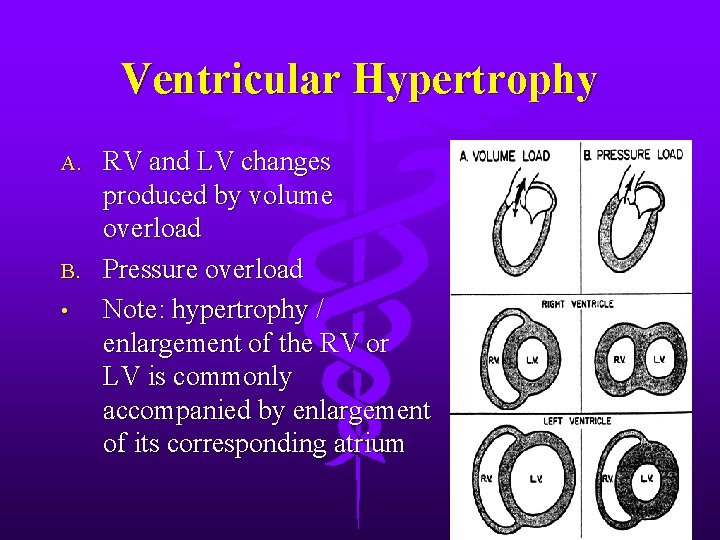 Ventricular Hypertrophy A. B. • RV and LV changes produced by volume overload Pressure Ventricular Hypertrophy A. B. • RV and LV changes produced by volume overload Pressure