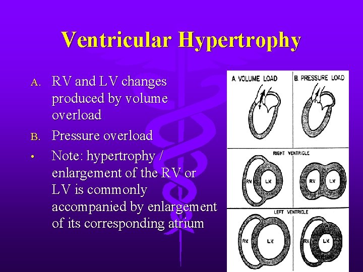 Ventricular Hypertrophy A. B. • RV and LV changes produced by volume overload Pressure