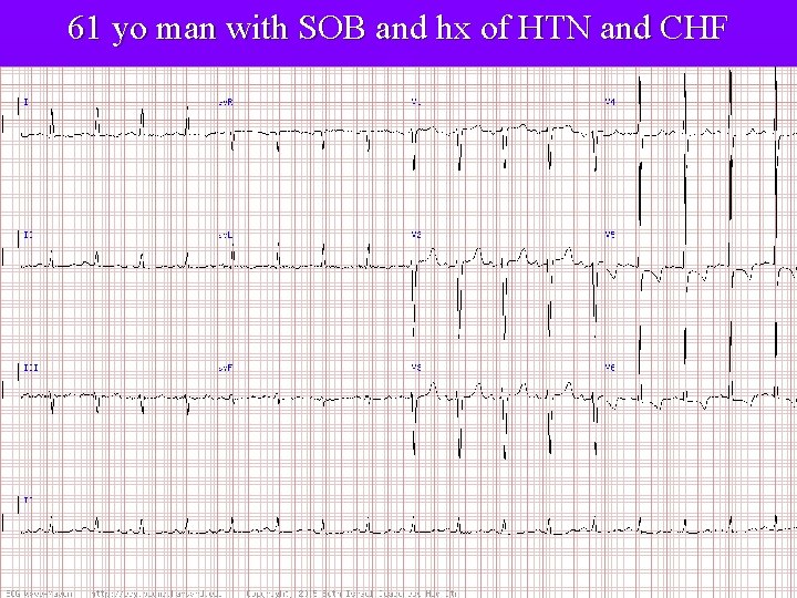 61 yo man with SOB and hx of HTN and CHF 