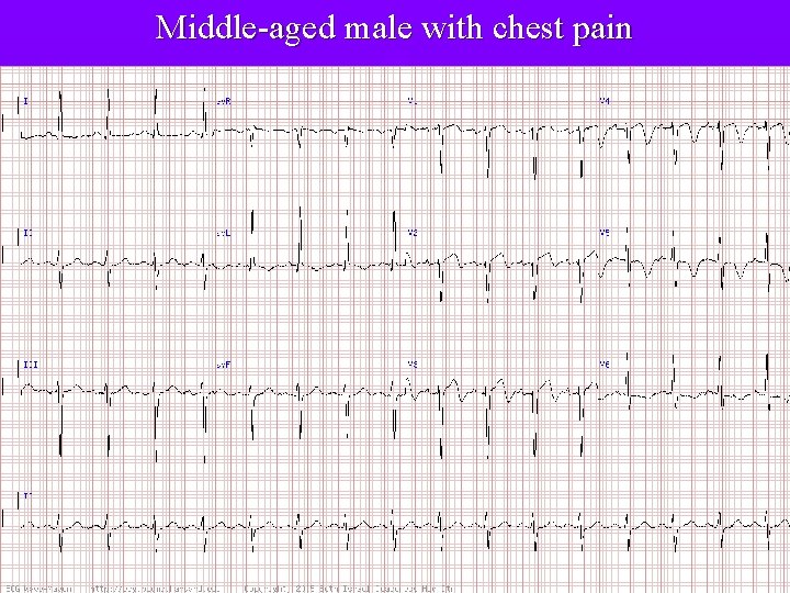 Middle-aged male with chest pain 