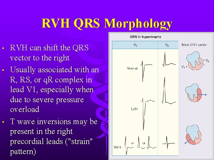 RVH QRS Morphology • • • RVH can shift the QRS vector to the