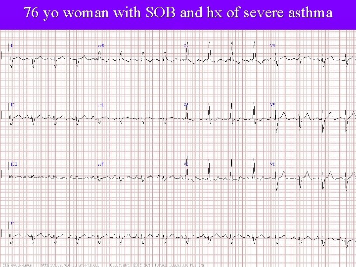 76 yo woman with SOB and hx of severe asthma 