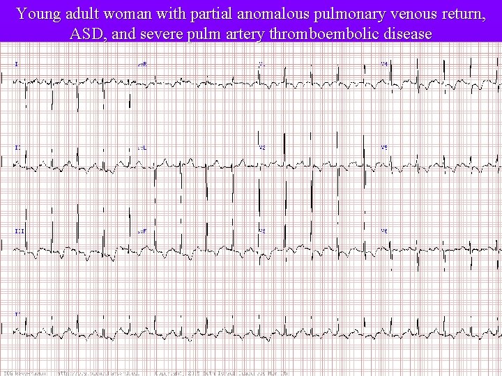 Young adult woman with partial anomalous pulmonary venous return, ASD, and severe pulm artery