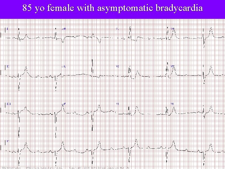 85 yo female with asymptomatic bradycardia 