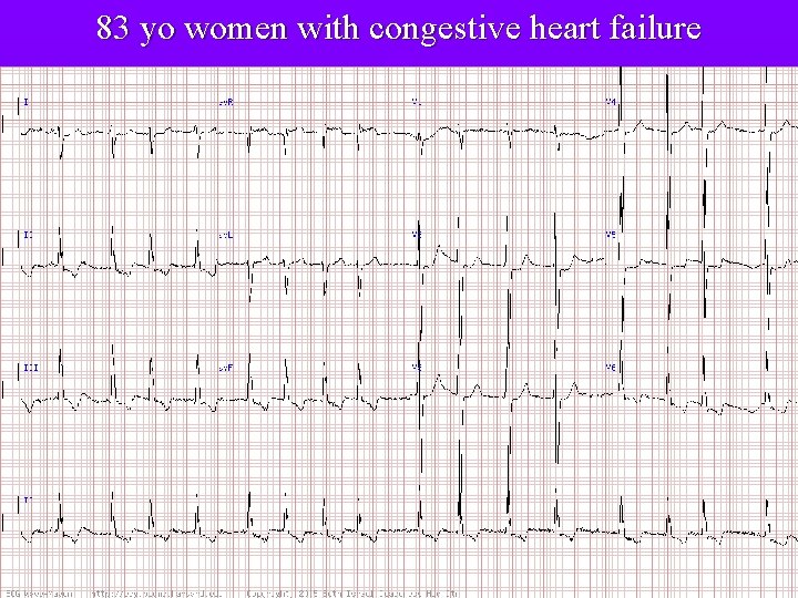 83 yo women with congestive heart failure 