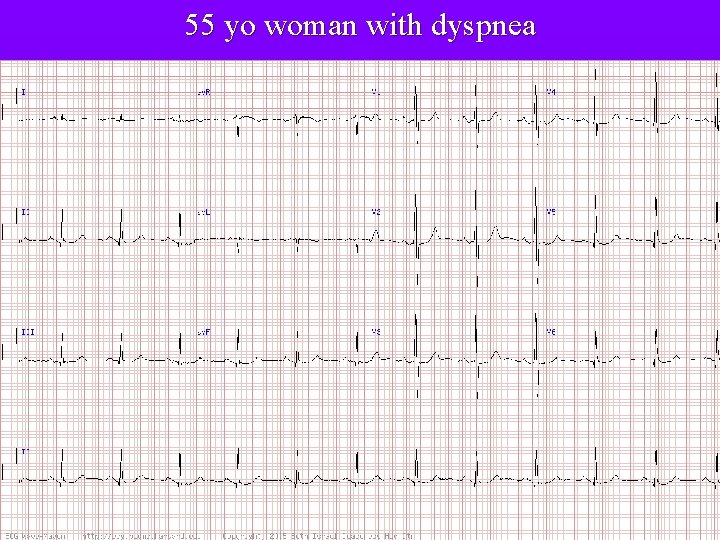 55 yo woman with dyspnea 