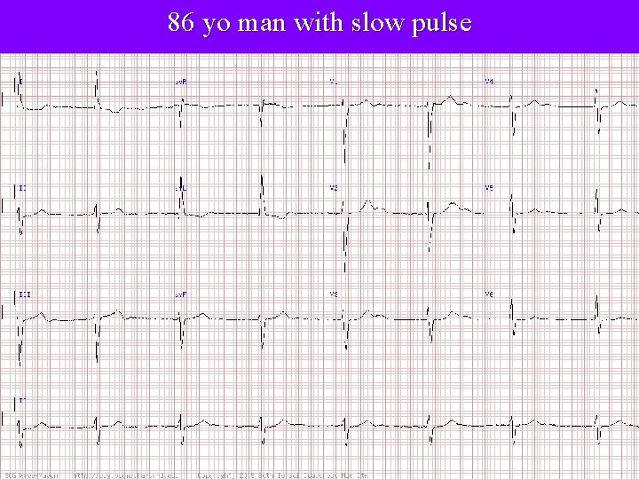 86 yo man with slow pulse 