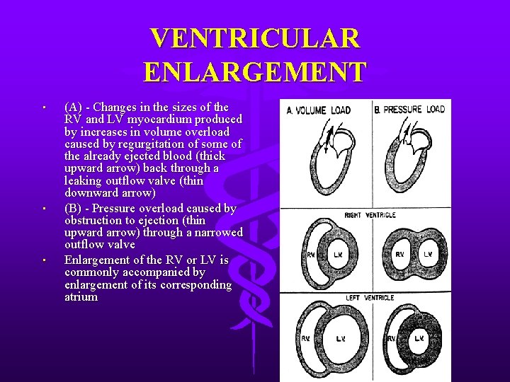 VENTRICULAR ENLARGEMENT • • • (A) - Changes in the sizes of the RV