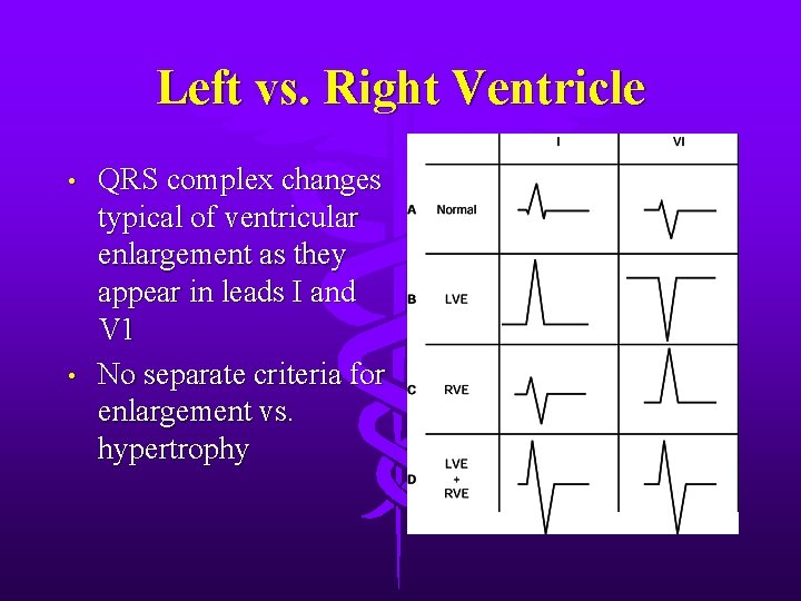 Left vs. Right Ventricle • • QRS complex changes typical of ventricular enlargement as