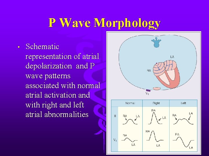 P Wave Morphology • Schematic representation of atrial depolarization and P wave patterns associated