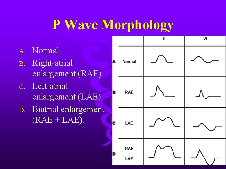 P Wave Morphology A. B. C. D. Normal Right-atrial enlargement (RAE) Left-atrial enlargement (LAE)