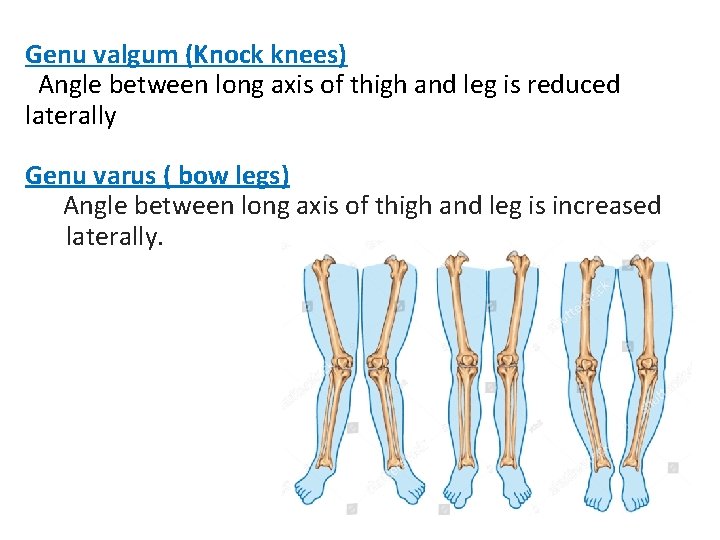 Genu valgum (Knock knees) Angle between long axis of thigh and leg is reduced