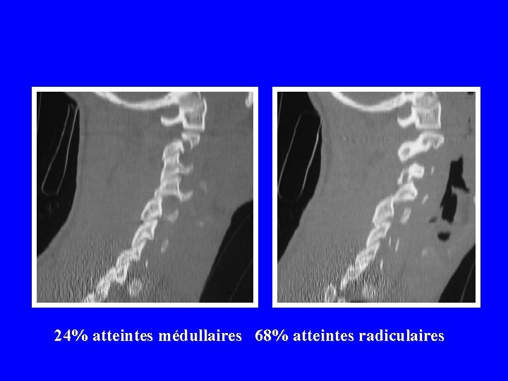 24% atteintes médullaires 68% atteintes radiculaires 