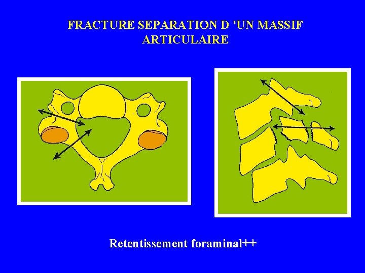 FRACTURE SEPARATION D ’UN MASSIF ARTICULAIRE Retentissement foraminal++ 