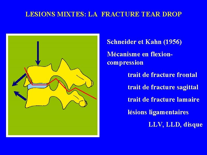 LESIONS MIXTES: LA FRACTURE TEAR DROP Schneider et Kahn (1956) Mécanisme en flexioncompression trait