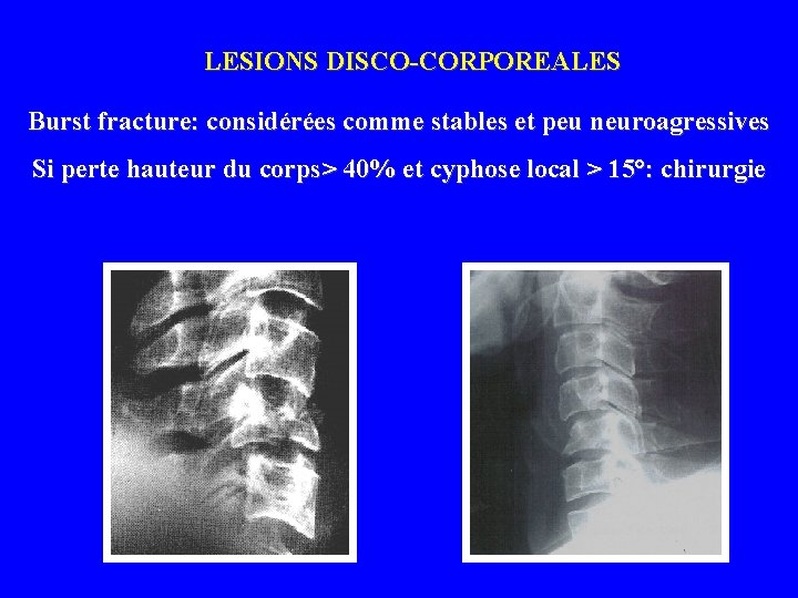 LESIONS DISCO-CORPOREALES Burst fracture: considérées comme stables et peu neuroagressives Si perte hauteur du