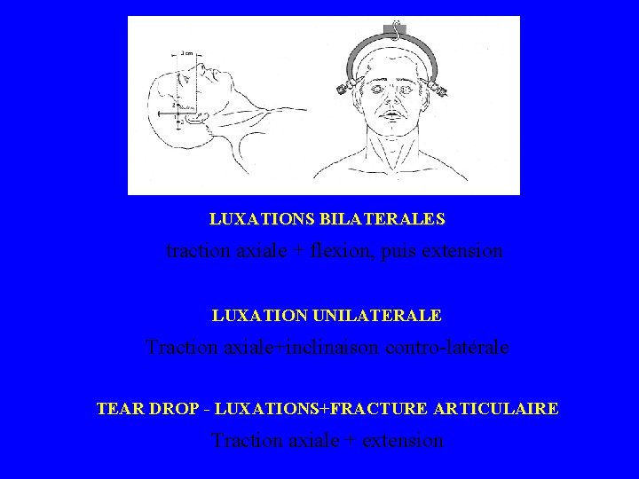  LUXATIONS BILATERALES traction axiale + flexion, puis extension LUXATION UNILATERALE Traction axiale+inclinaison contro-latérale
