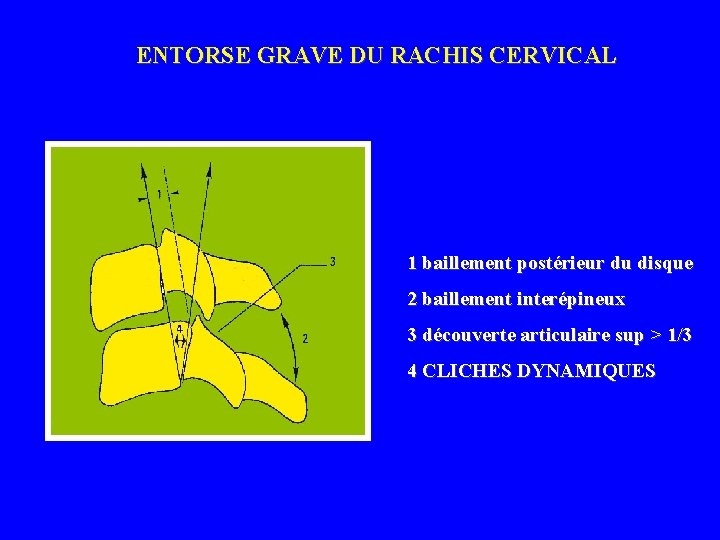 ENTORSE GRAVE DU RACHIS CERVICAL 1 baillement postérieur du disque 2 baillement interépineux 3