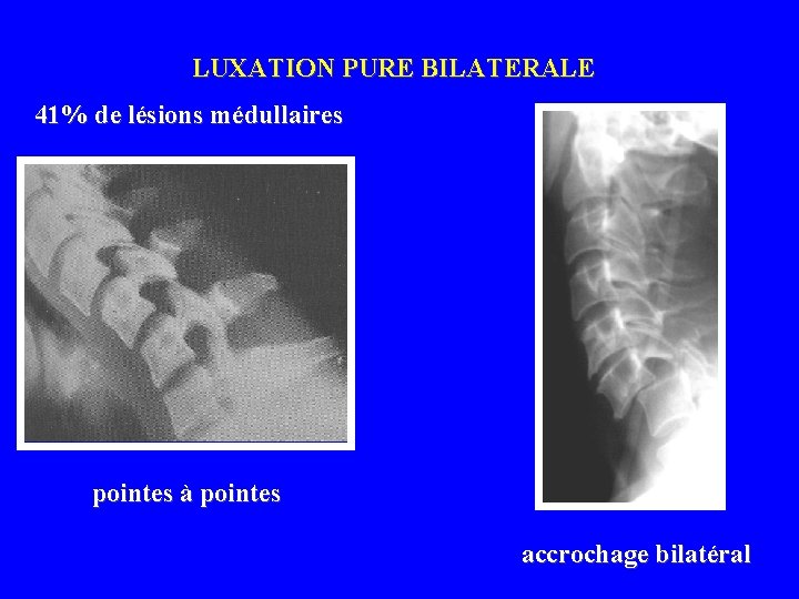 LUXATION PURE BILATERALE 41% de lésions médullaires pointes à pointes accrochage bilatéral 