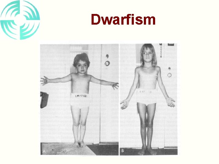 Dwarfism 