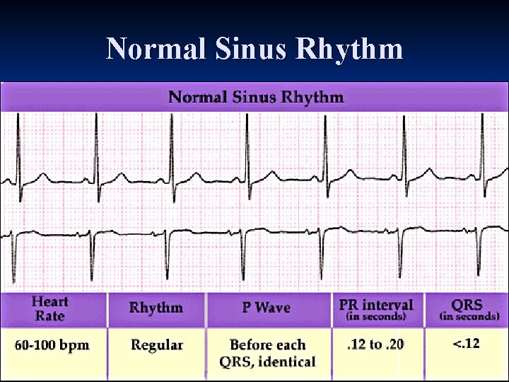 Normal Sinus Rhythm 