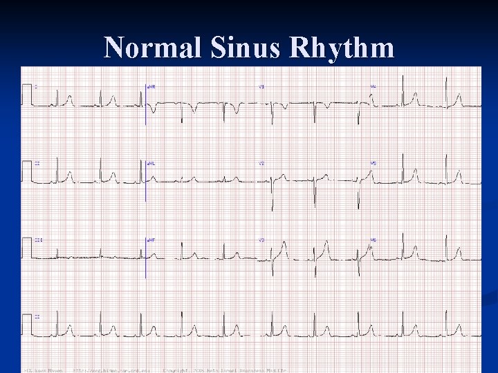 Normal Sinus Rhythm 