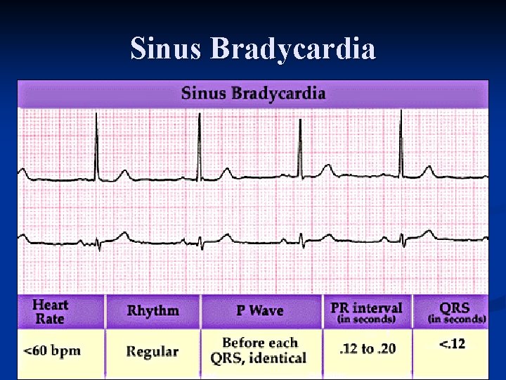 Sinus Bradycardia 