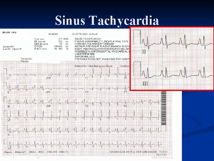 Sinus Tachycardia 