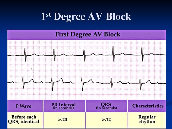 1 st Degree AV Block 