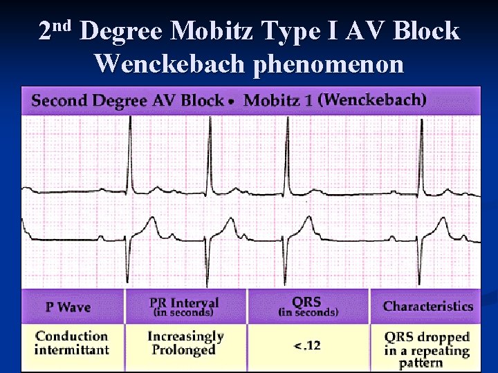 2 nd Degree Mobitz Type I AV Block Wenckebach phenomenon 